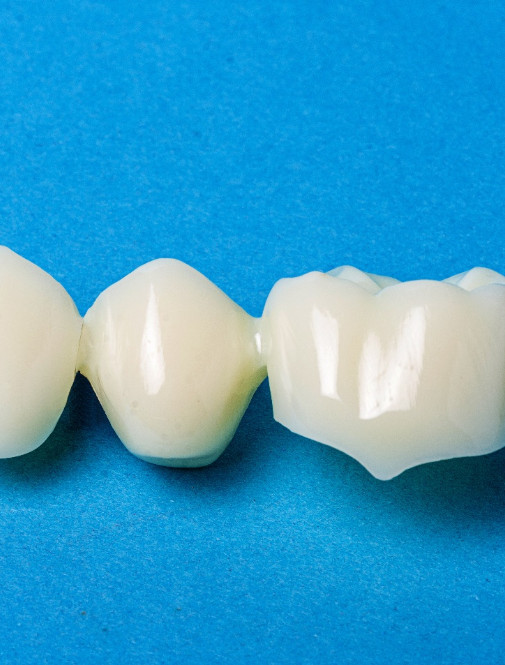 Three-unit dental bridge against blue background