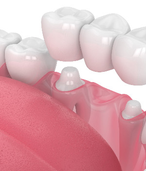 Illustration of dental bridge being placed on prepared teeth