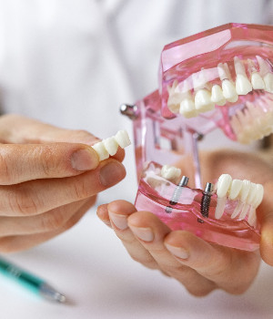 Dental professional using model to explain implant bridge