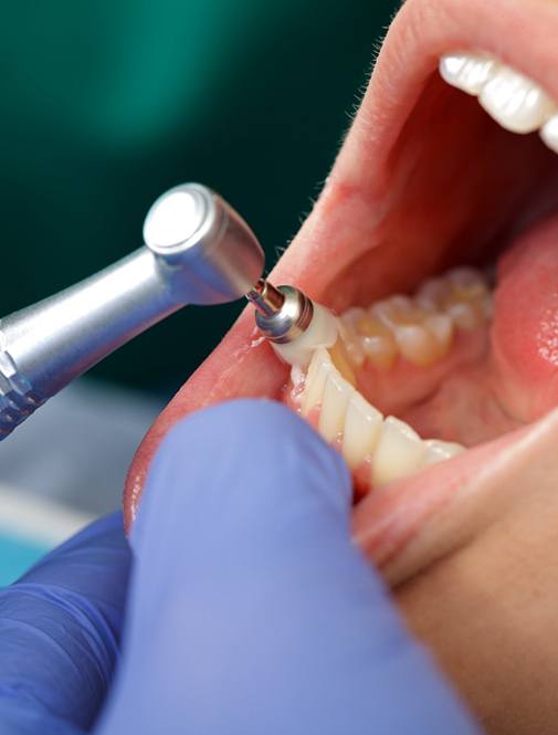 Close-up of patient&rsquo;s mouth during a dental cleaning