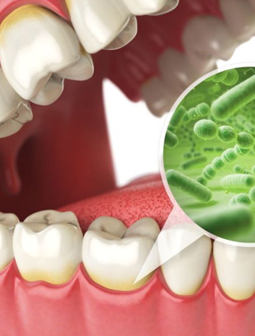 Illustration of bacteria along gumline