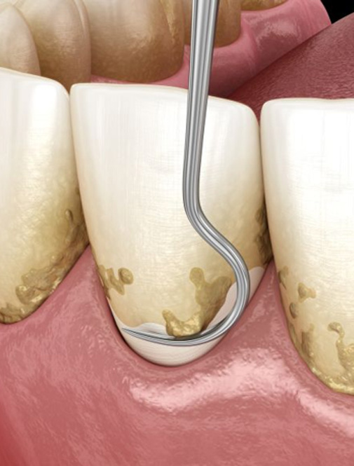 Illustration of dental scaler cleaning teeth